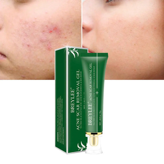 Acne Scar Removal Gel Tea Tree Qu Dou Printing - Huy&