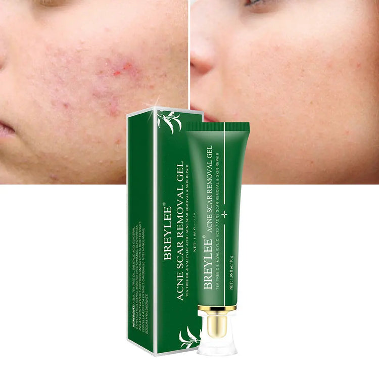 Acne Scar Removal Gel Tea Tree Qu Dou Printing - Huy&