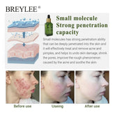 BREYLEE Acne Treatment Serum Face Facial Anti Acne Scar Removal Cream Skin Care Whitening Repair Pimple Remover For Acne - Huy&