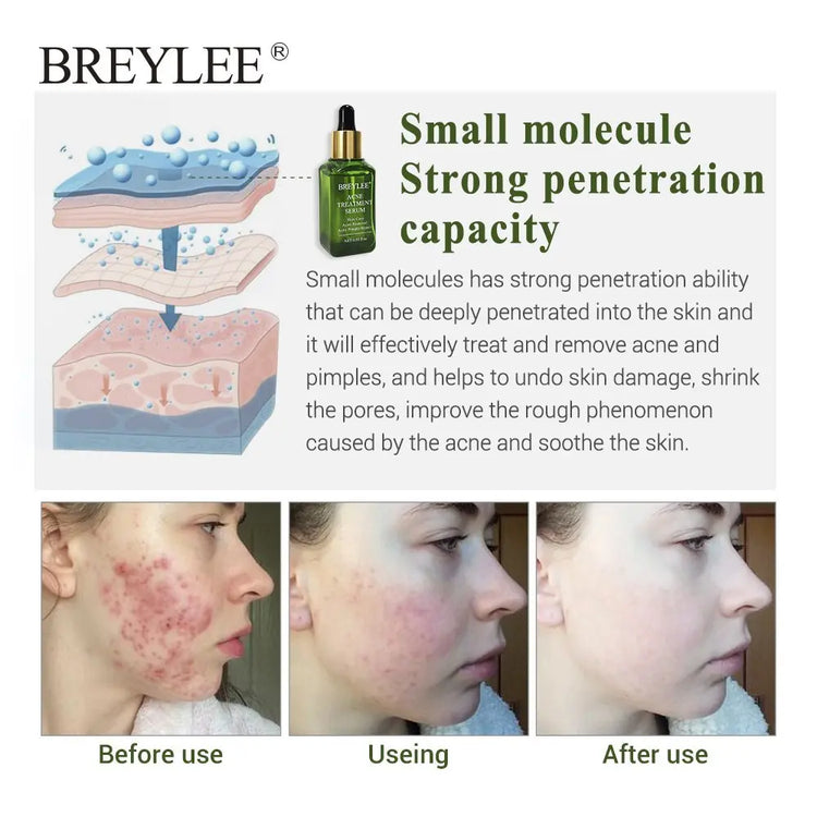 BREYLEE Acne Treatment Serum Face Facial Anti Acne Scar Removal Cream Skin Care Whitening Repair Pimple Remover For Acne - Huy&
