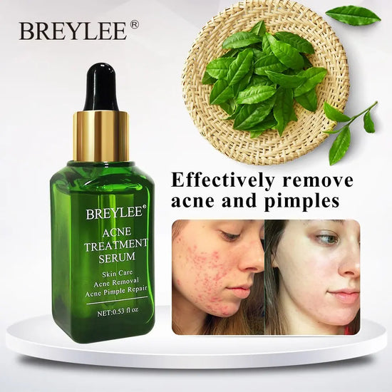 BREYLEE Acne Treatment Serum Face Facial Anti Acne Scar Removal Cream Skin Care Whitening Repair Pimple Remover For Acne - Huy&