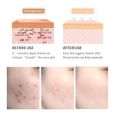 Acne Scar Removal Gel Tea Tree Qu Dou Printing - Huy&
