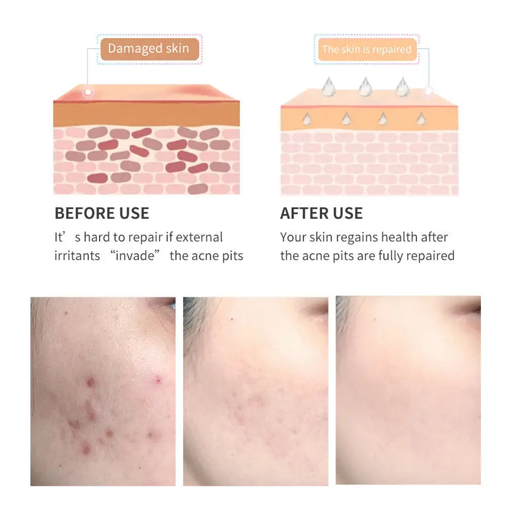 Acne Scar Removal Gel Tea Tree Qu Dou Printing - Huy&