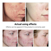 BREYLEE Acne Treatment Serum Face Facial Anti Acne Scar Removal Cream Skin Care Whitening Repair Pimple Remover For Acne - Huy&