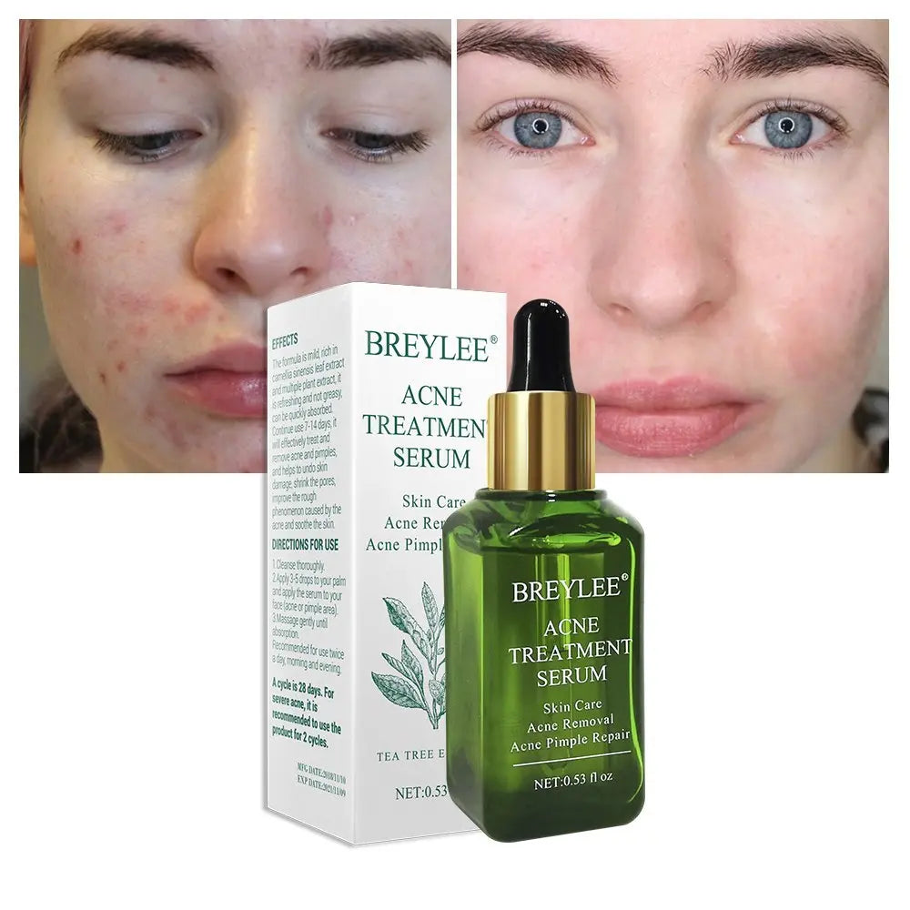 BREYLEE Acne Treatment Serum Face Facial Anti Acne Scar Removal Cream Skin Care Whitening Repair Pimple Remover For Acne - Huy&
